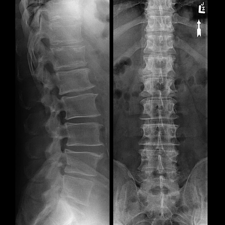 X-ray of the thoracic region, which shows a decrease in the gap between the vertebrae along the spine from bottom to top