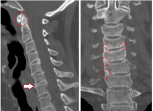The CT scan shows damaged vertebrae and discs of heterogeneous height due to thoracic osteochondrosis