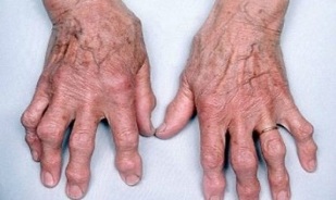 how to distinguish arthritis of fingers from arthrosis