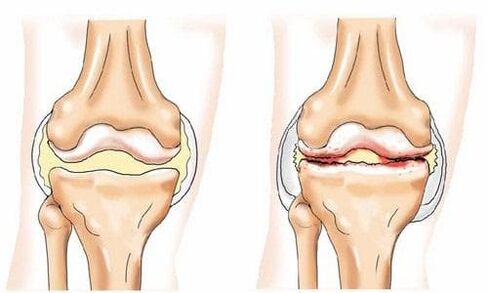 healthy and arthrosis-affected knee joint