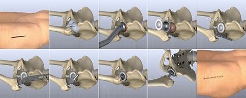 methods of treating hip arthrosis
