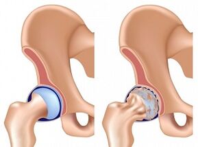 symptoms of hip arthrosis