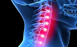 manifestations of osteochondrosis of the cervical spine